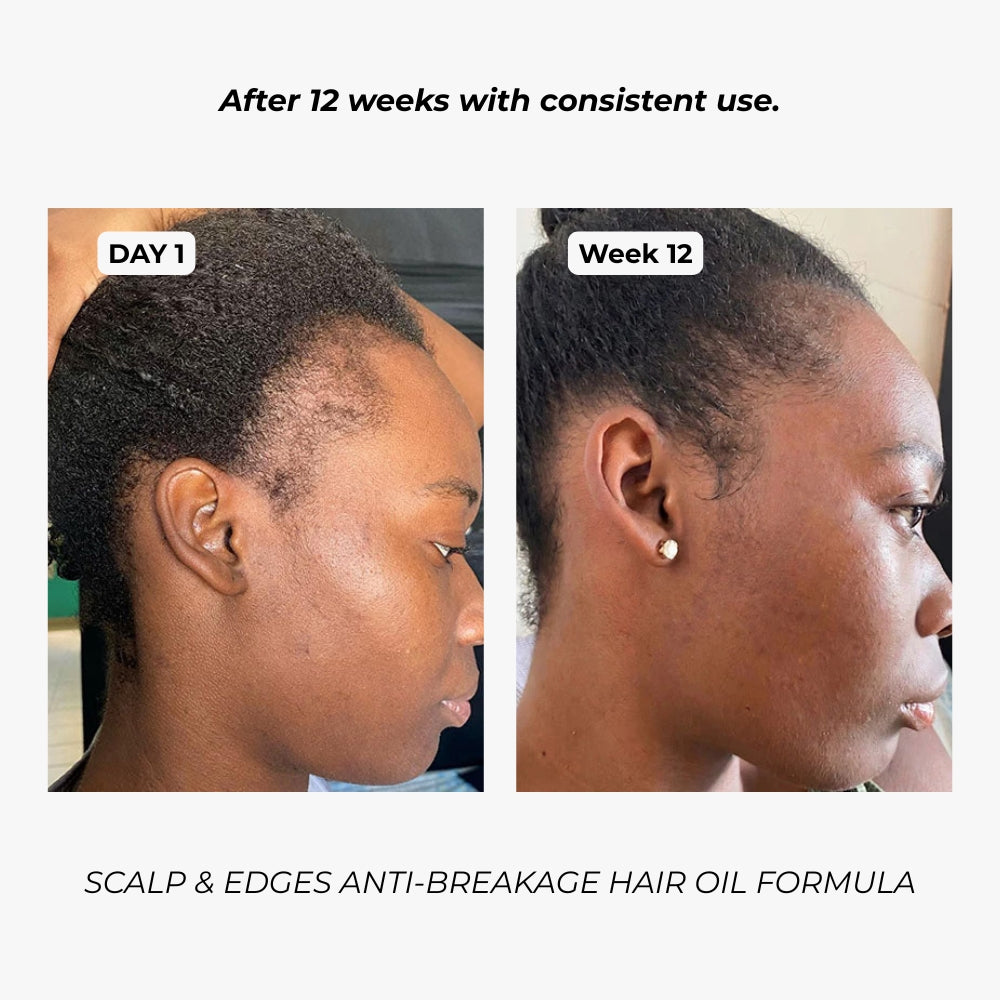 7-in-1 Scalp, Edges & Hairline Restore Formula